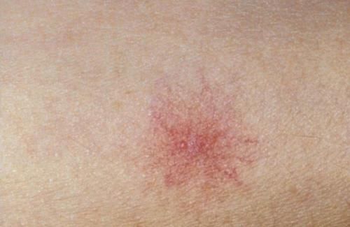 肝功能|肝功八项都正常说明肝正常吗？非也