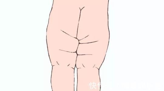 宝宝|宝宝腿纹不对称跟髋关节发育不良有什么关系,3种情况要注意