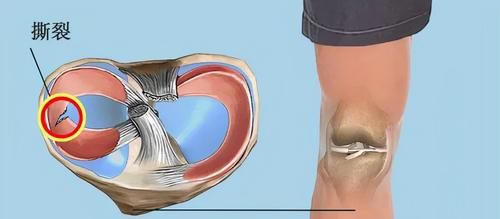 运动损伤|「半月板」最怕的一个动作，分分钟加速它的“报废”！