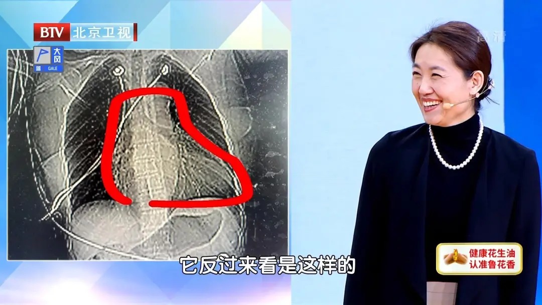 心衰|血压高的不多,为何也会心衰高血压人群,这两点一定要了解