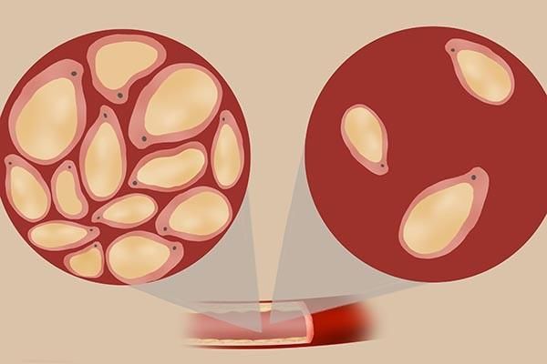 甘油三脂高3.2，严重吗？算不算是高血脂？医生给出详细解读