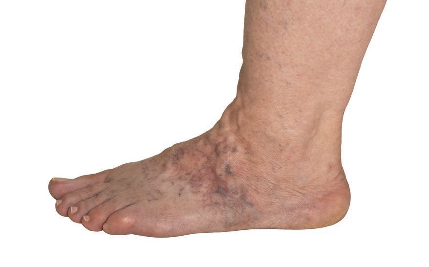 双脚|人老脚先衰？多留意双脚7种表现，若你有，或已进入衰老状态