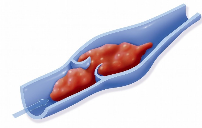 深静脉血栓|血栓形成后,腿脚容易出现4个异常,若一个没有,血管还算通畅