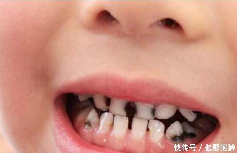 罪魁祸首|3岁宝宝满口“小黑牙”,罪魁祸首并非糖果,而是家长的无知