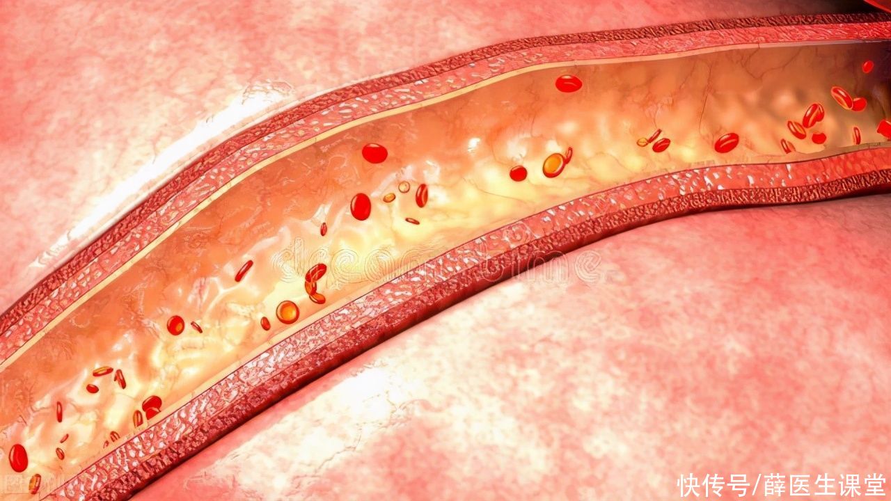 心绞痛|硝酸甘油，是炸药也是救命药！但有这7种情况的人不能吃