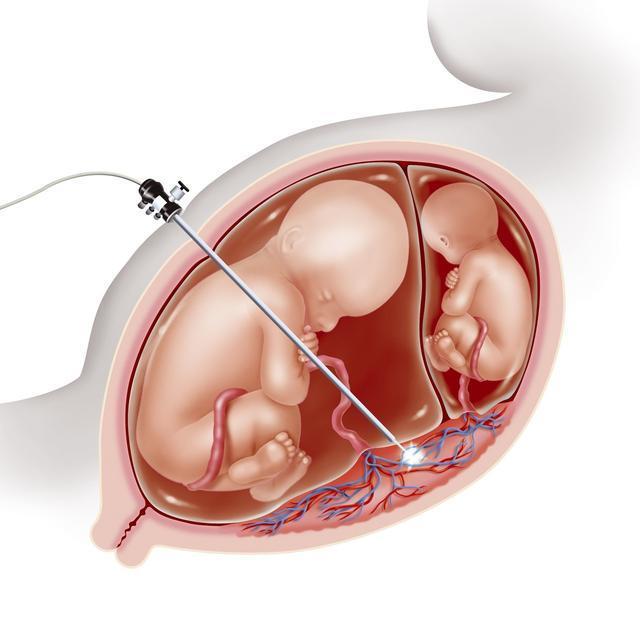 后壁|胎盘前壁和后壁有什么区别3个区别很重要,3个区别可忽视