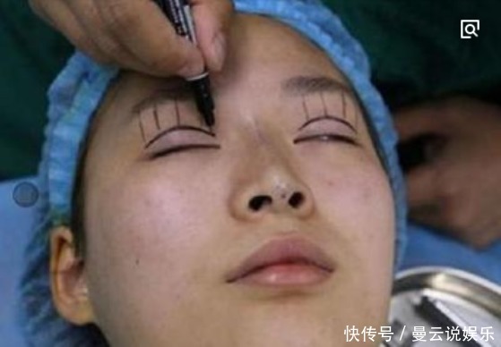 手术割了双眼皮的人,老了之后有什么影响看完真要留意了