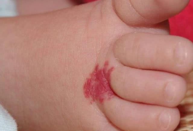 胎记|怀孕时,孕妇最好别做这4事,当心宝宝身上会留“胎记”,再喜欢也要忍住