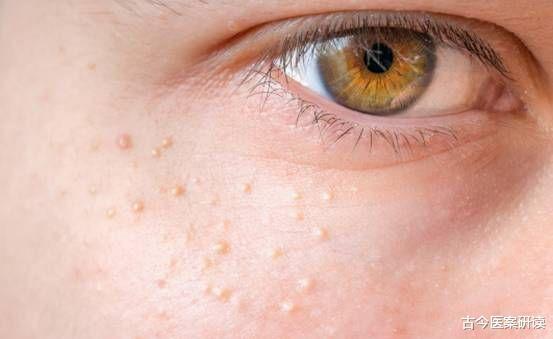 医生|29岁女子患上“高血脂”,医生:这“2”物再馋也要忍住,否则“堵上添堵”