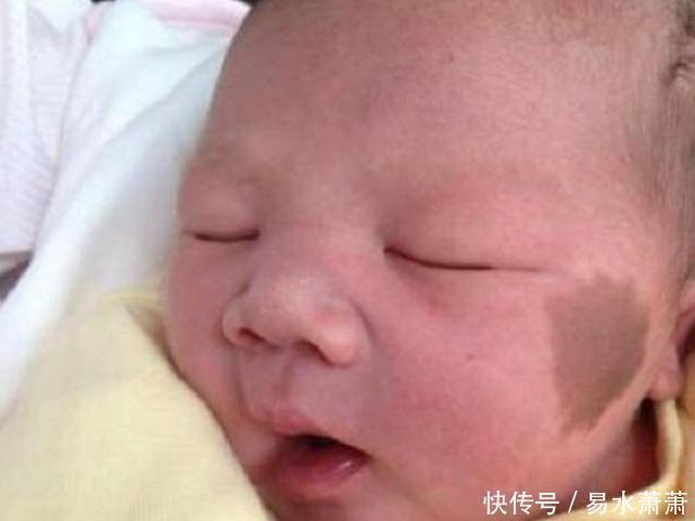 李女士|为什么有的宝宝会有“胎记”产科医生孕期要避免这3种行为