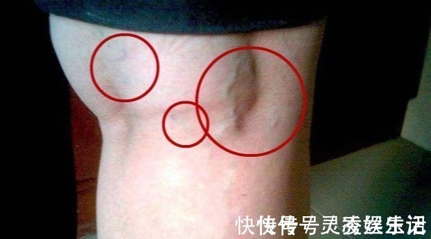 五分处|痔疮也有“对应穴”,一穴在手一穴在腿,每天拍一拍可能痔疮消失