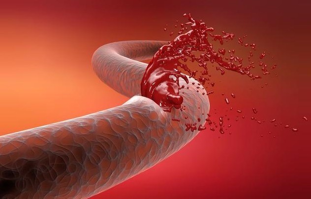 脑血管|“中风”为何越来越多直言改掉饭后3个习惯,脑血管会更健康