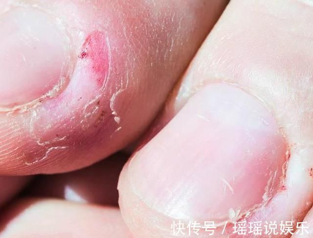 指甲|研究发现:爱咬指甲的孩子,都逃不过这5种结局!