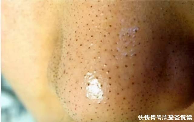 小苏打|常见的4种错误的除黑头方法,奉劝:不要再用了,越除黑头越多