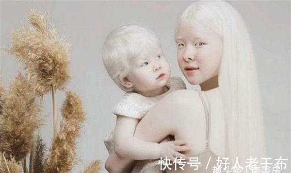 白化病|这对神奇的姐妹俩，曾一出生便浑身“无颜色”，如今粉丝遍布全球