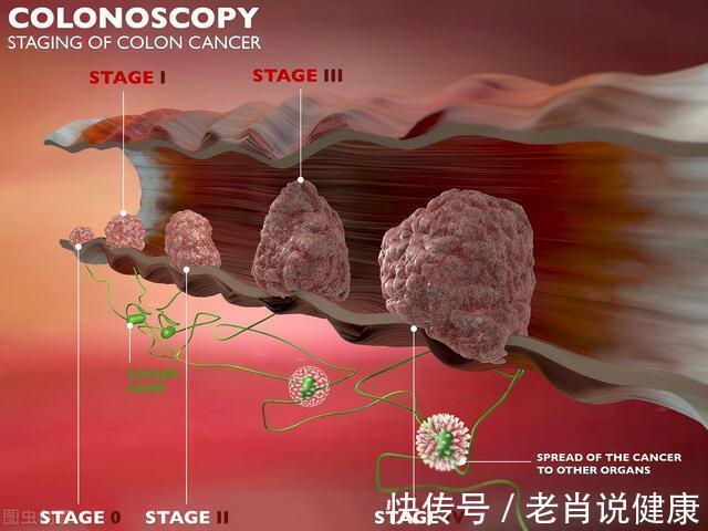 肠癌|心肝宝贝奖门人:癌症都是由小病演变而成?医生:生活中4种常见小毛病,要多留心