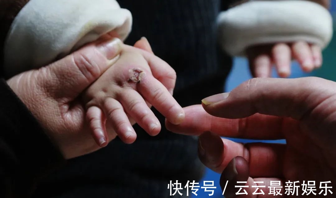 治疗费|漂亮女童身怀“特异功能”,没有痛觉,不会出汗,爸妈却因她流泪