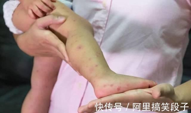 蚊虫|宝宝被蚊虫叮咬后,90%妈妈都做错!擦这个止痒最有效!