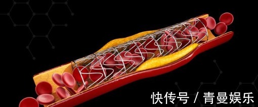 狭窄|辟谣冠心病放了支架就一劳永逸了这3点做不好,还会有风险