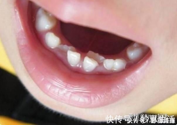 人的一生|孩子乳牙整齐漂亮,换牙后却越来越“歪”可能是这几点没做好