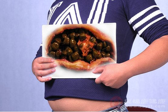 膽結石患者的禁忌食物有哪些