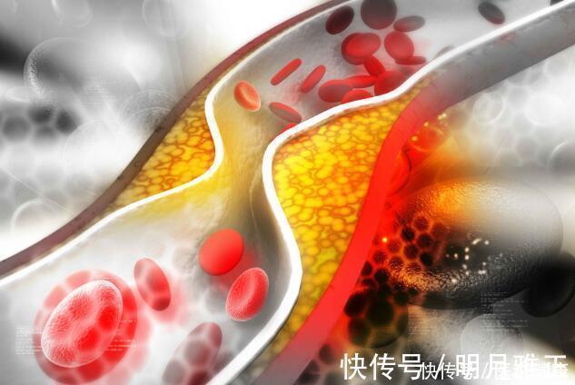 血脂異常|高血脂的4大狀態，要心中有數，若你有，高血脂已找上你了