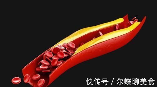 血脂|心血管问题服用阿司匹林和他汀,医生提示6个方面,助你安全用药