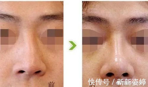 假体|为什么你做的隆鼻没达到预期效果?吸取教训,这些雷别踩!