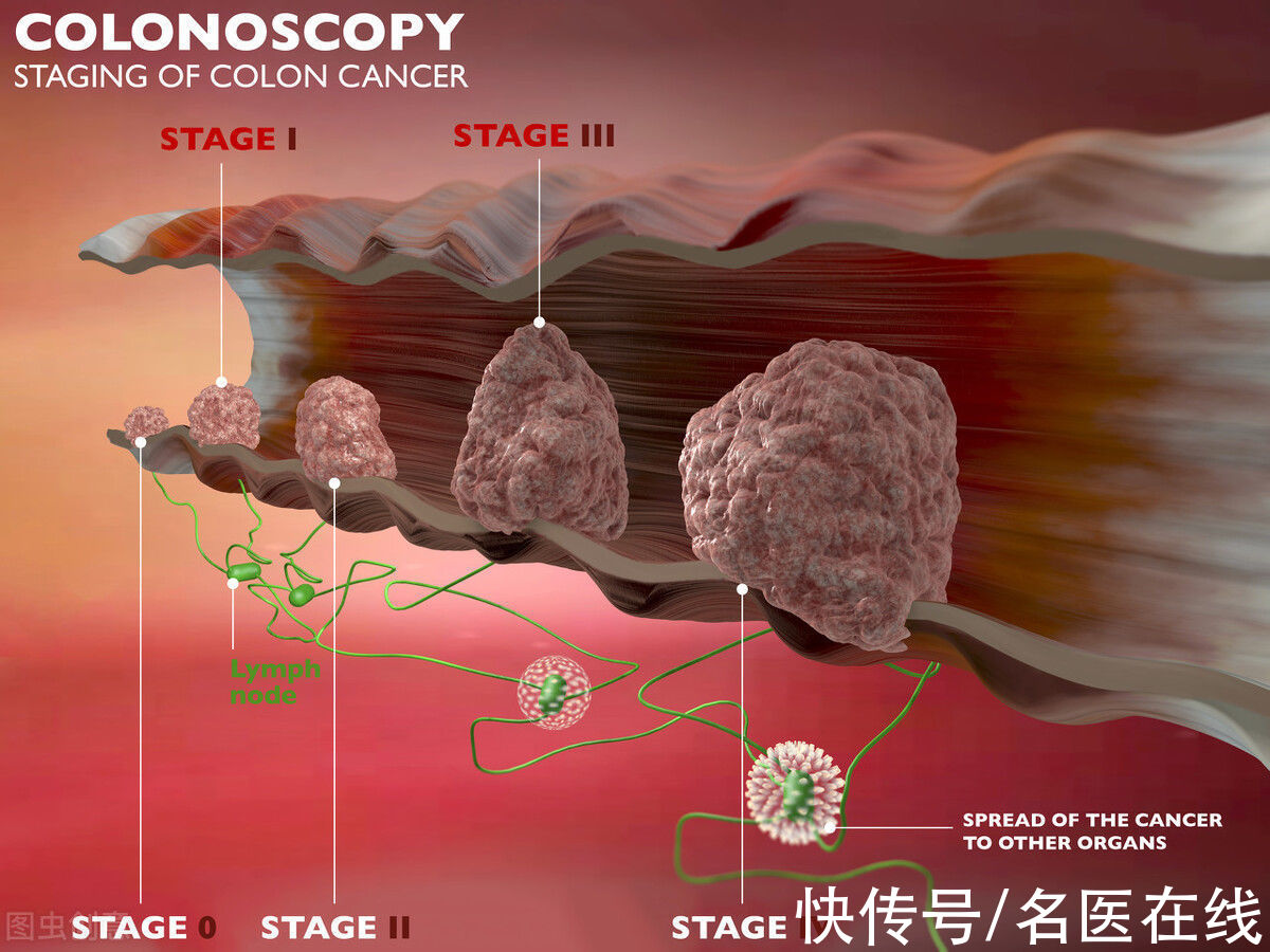 肠癌|大肠癌上门，身体会发出5种警示！这7类高风险人群要提前注意