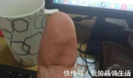 横纹|大拇指上暗藏的中风信号,一旦出现赶紧就医