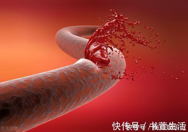 高血压|家人突发脑出血咋办?医生教你家庭急救办法,家人有高血压的请看