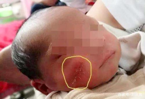 负面情绪|5年过去了,当年喝母乳被妈妈用剪刀划伤脸的男婴,现在如何了?