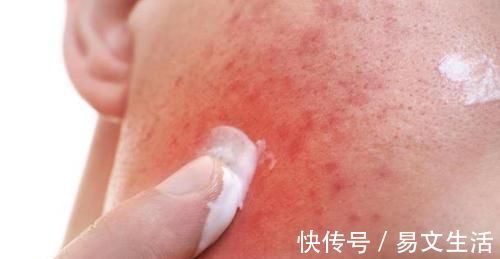 痘痘|痘痘,用什么药效果好?可以尝试用5种药!