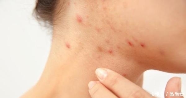 尘螨|床上螨虫太多?教你3个不要钱的“土法子”, 把螨虫“赶尽杀绝”