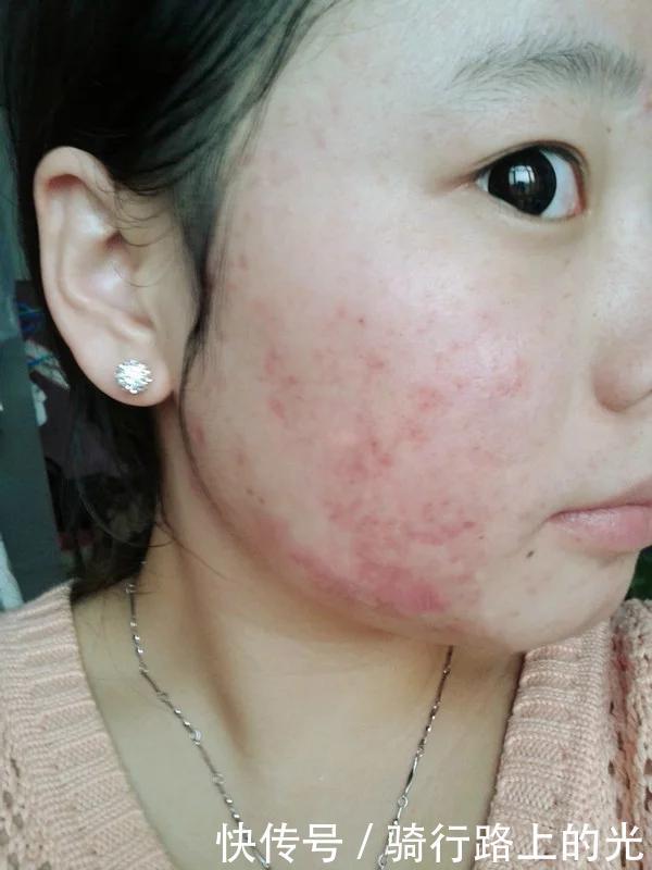 断货王|那些“断货王护肤品”太坑了,粉水、黄油均上榜,用完长痘还过敏