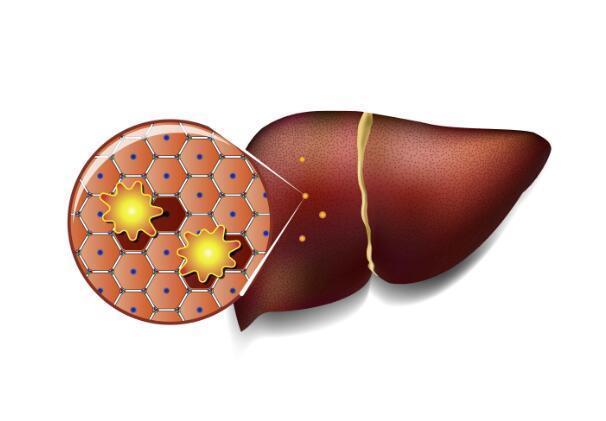 高血脂不控制,当心引发这9种并发症,每个都不能忽视