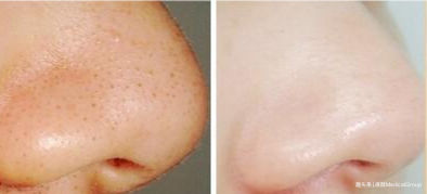 鼻子上总出黑头，可以随便挤它么？