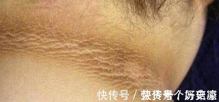 婷婷|6岁小女孩脖颈发黑洗不掉,去医院做检查,医生的话让妈妈笑了