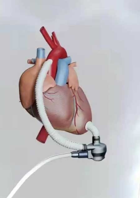 植入|男子植入人工心脏,随身携带小挎包每天为“心”充电