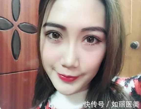 褶皱 做完双眼皮手术后老气?这2个因素帮你盘点盘点