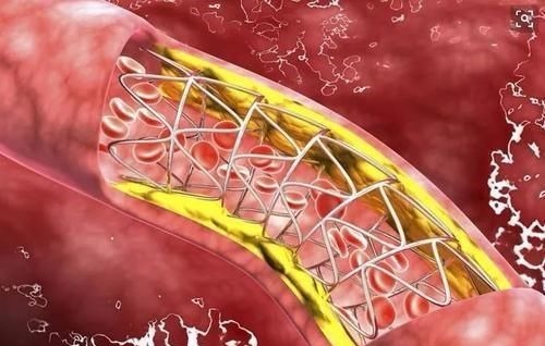 出血脂|血脂高不高,”小腿“先知?医生:血脂偏高,身体或有这几个表现