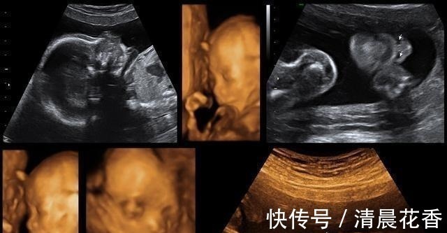 四维|做四维时宝宝趴着不愿意动,原来是这些原因,做好这点一次通过