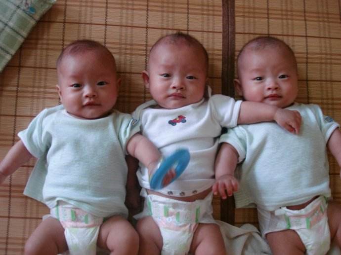连体婴儿|产妇怀上畸形3胞胎,却拒绝引产,现如今的生活令人羡慕不已