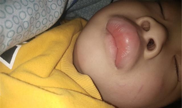 蚊虫|一觉醒来,儿子被蚊子咬成“香肠嘴”,妈妈心疼又不知所措