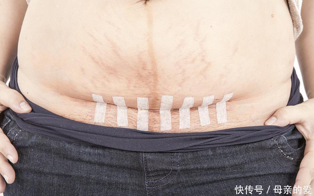 a34|剖腹产5个月后又怀孕了,宝妈坚持生下来,医生:赶紧住院手术吧