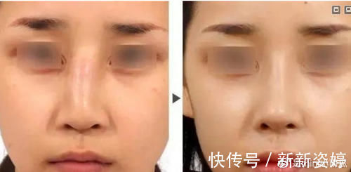 假体|为什么你做的隆鼻没达到预期效果?吸取教训,这些雷别踩!