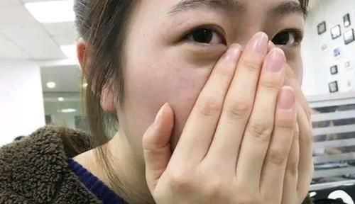 鼻子两侧的白色分泌物是什么东西?为何越挤越多?一起来了解一下