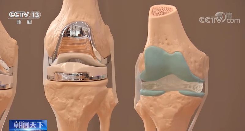 人工关节|国家组织人工关节集中带量采购 本次国家集中带量采购有哪些新变化？