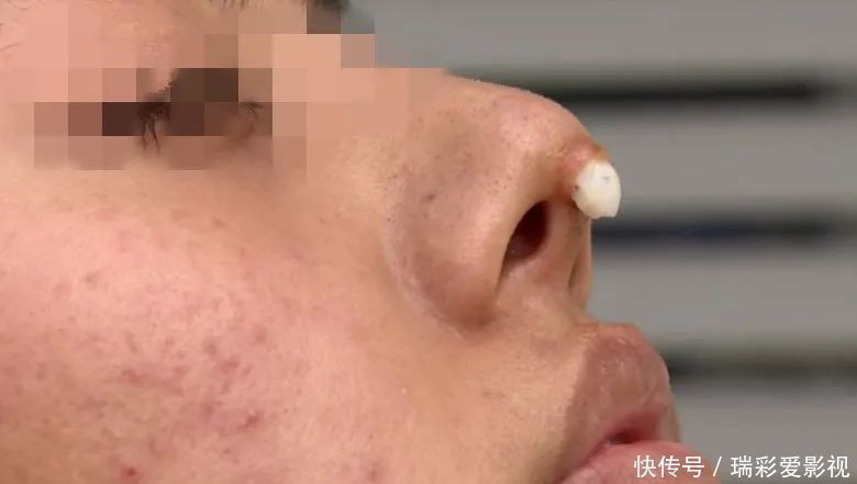 怀孕 漂亮姑娘刚怀孕,鼻尖出现神秘白色物体!婆婆追问下,她瞒不住了……