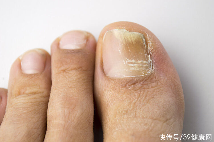 复发|得了灰指甲怎么治？这2个治疗方法效果好，安全不复发，赶紧学学